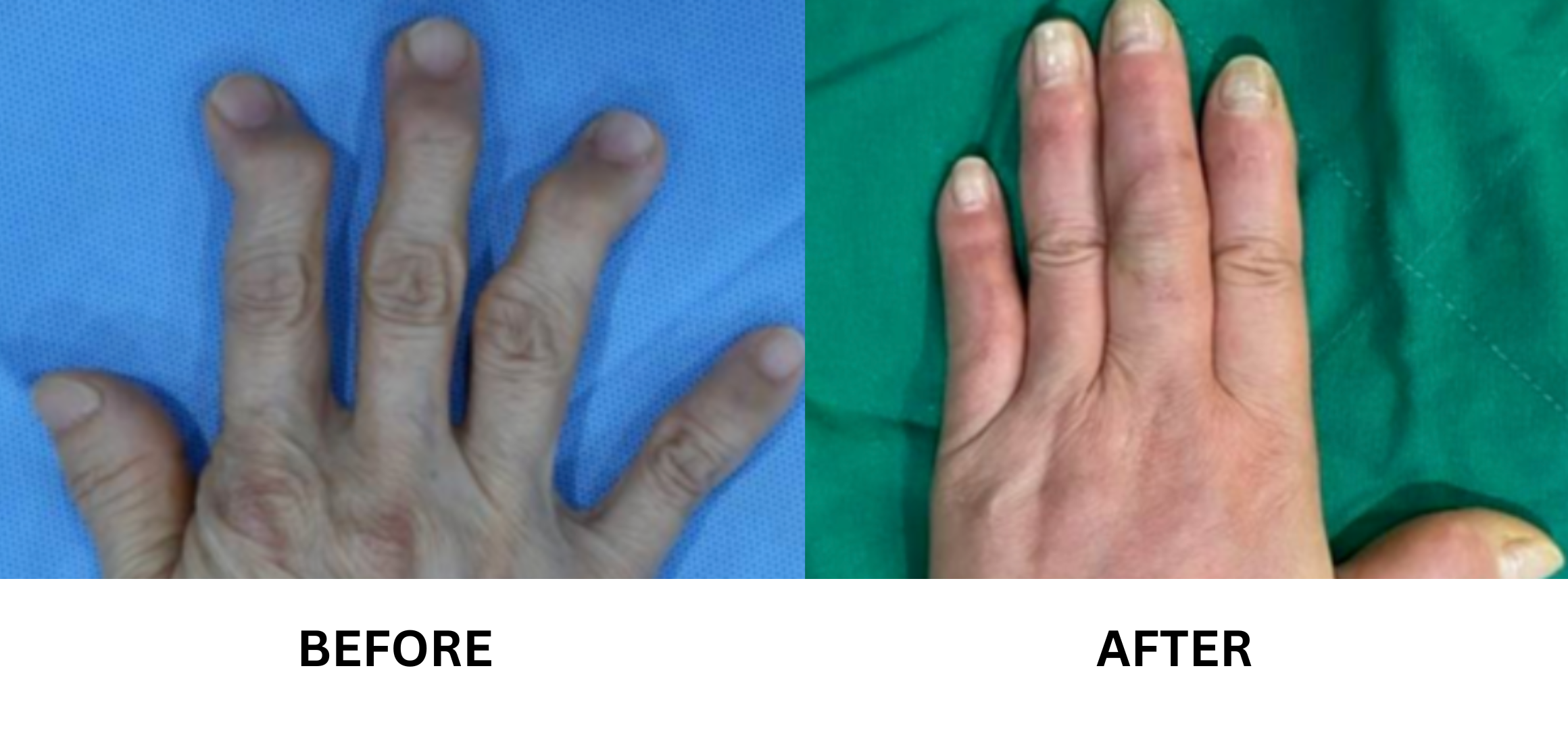 Getting Finger How I Stopped My Finger From Locking in Just Two Weeks – HYGGEAR